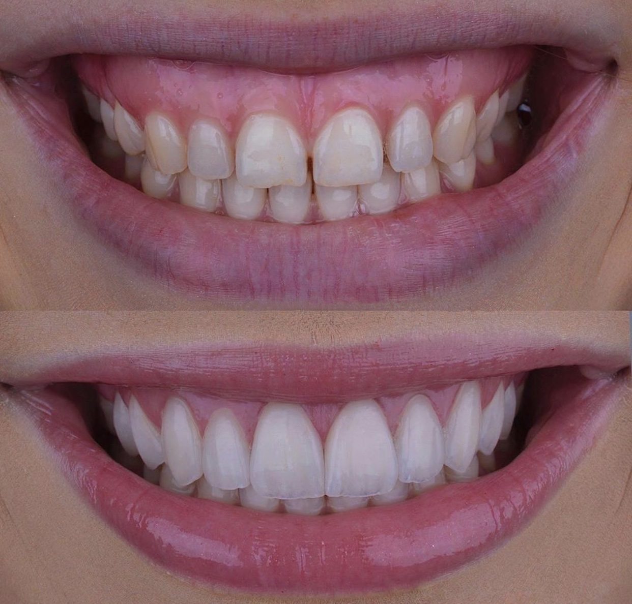 Керамічні вініри та коронки з подовження коронкової частини зуба